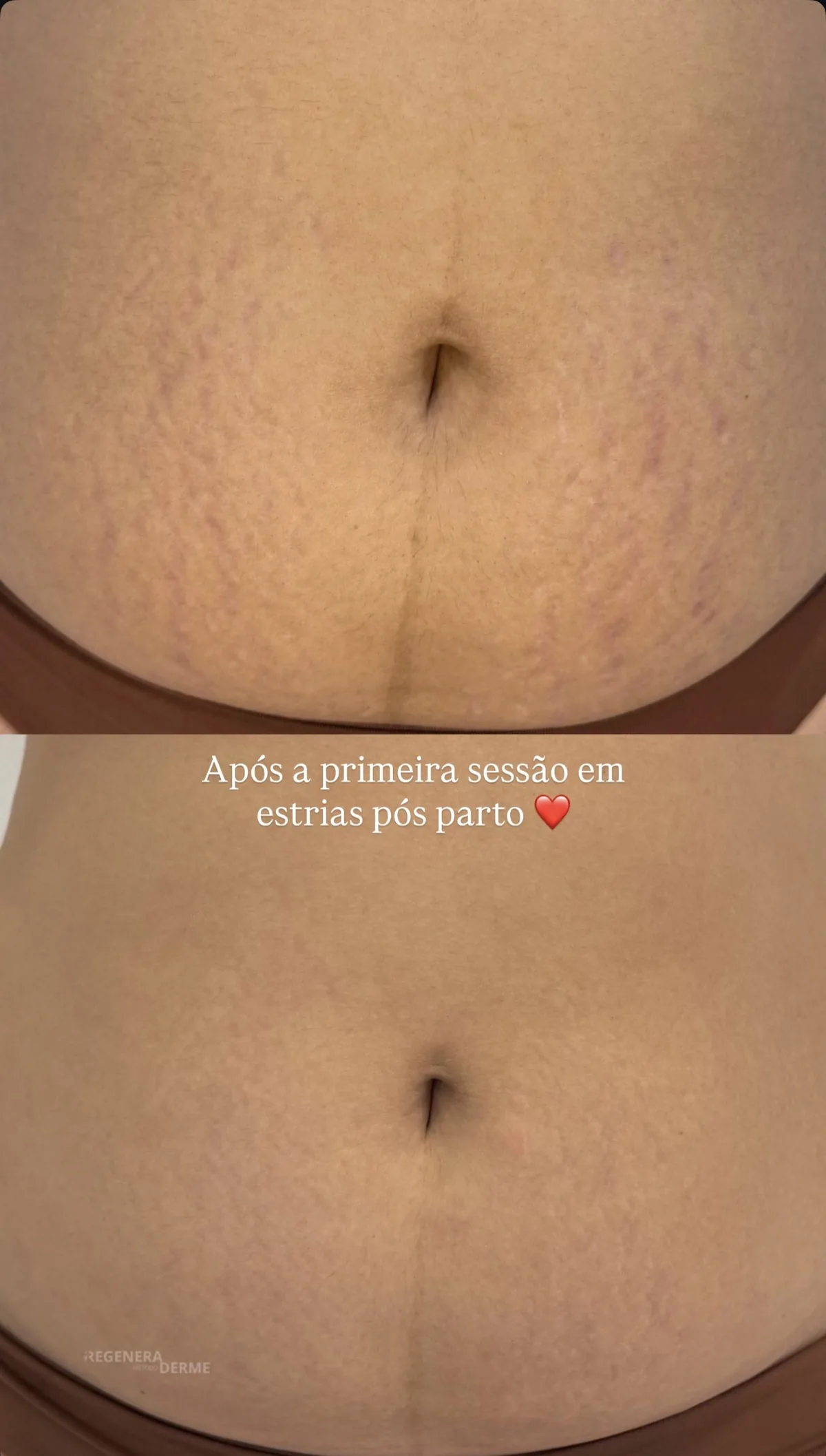 Pós-gestação após uma sessão