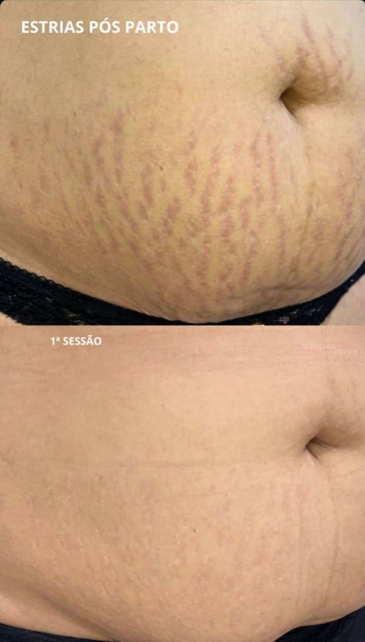 Evolução abdominal documentada