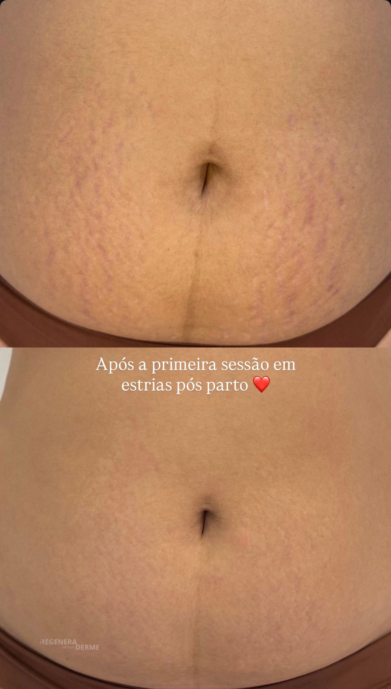 Resultado inicial em estrias pós-parto