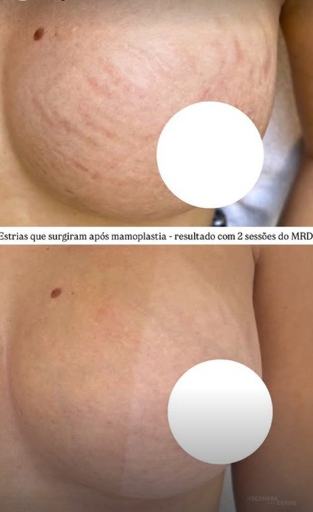 Estrias após 2 sessões